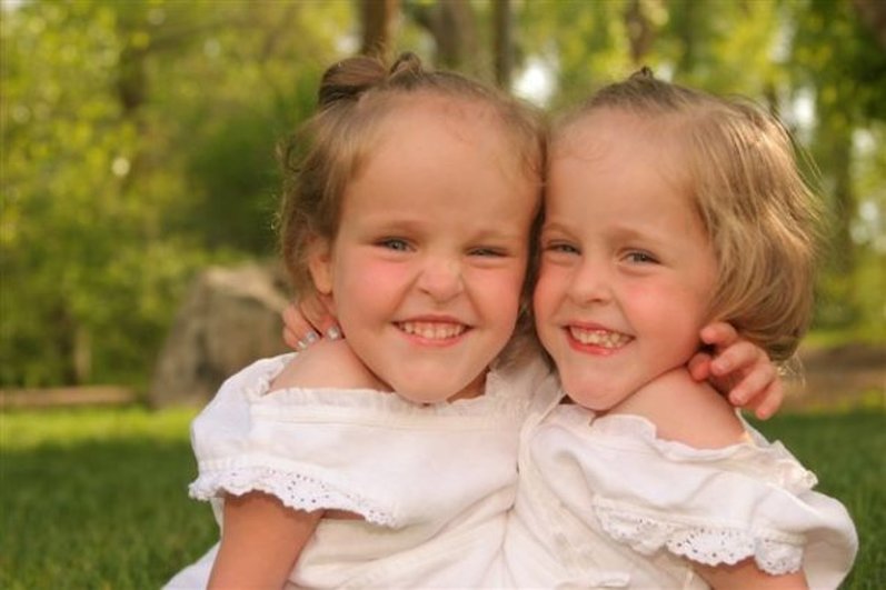 Этих сиамских близнецов разделили в 4 годика, сейчас им по 18 лет. Как они теперь живут?