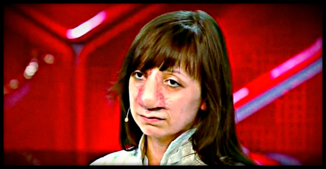Как сейчас выглядит Яна Муратова, которая пережила 19 операций на носу